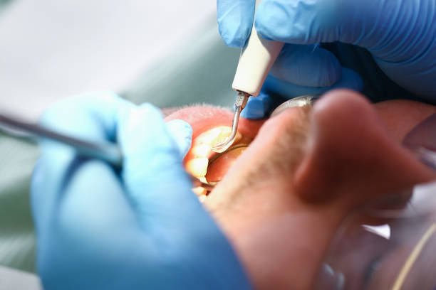 Best Emergency Dentist for Lost Fillings or Crowns in Gloucester Point, VA